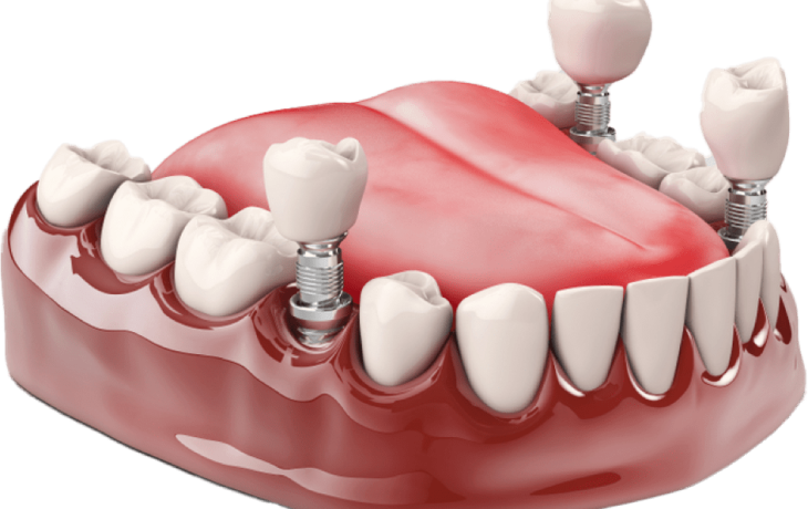 dental implants cheshire