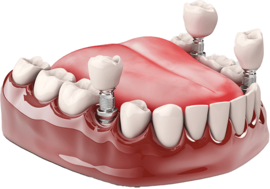 dental implants cheshire