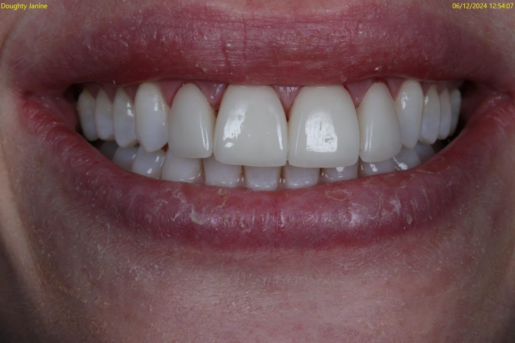 veneers treatment at crown bank dental after image