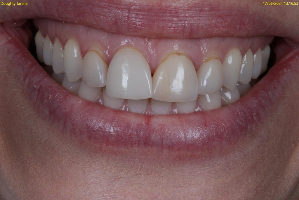 veneers treatment at crown bank dental before image