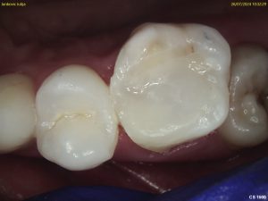 Root Canal Treatment - Crown Bank Dental After