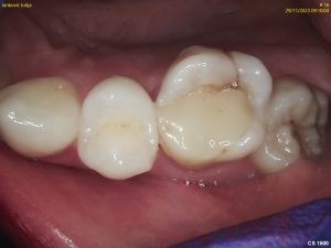 Root Canal Treatment - Crown Bank Dental Before