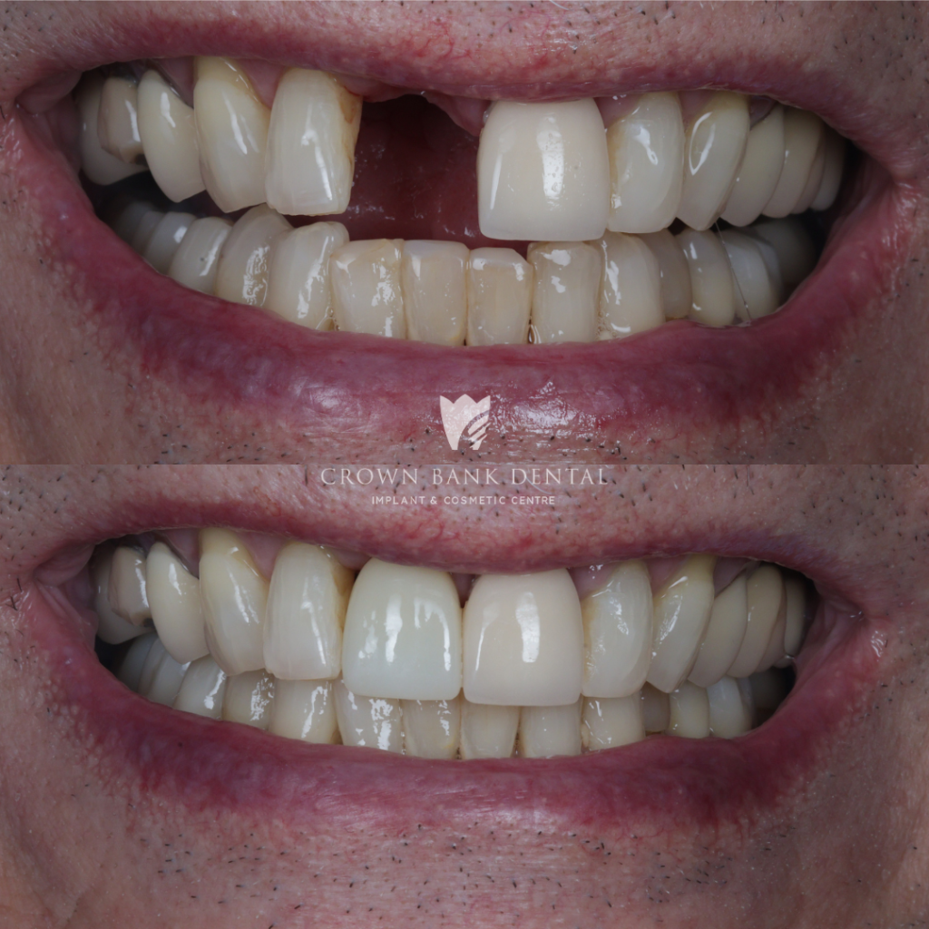 Dental implants at Crown Bank Dental before and after